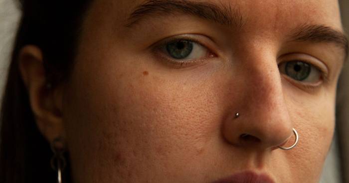Hormonal acne